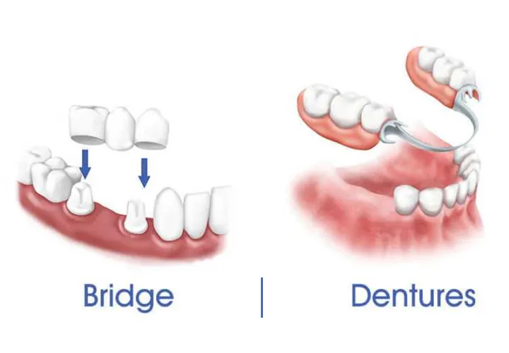 Clear Aligners