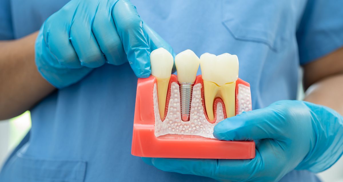 Dental Implants